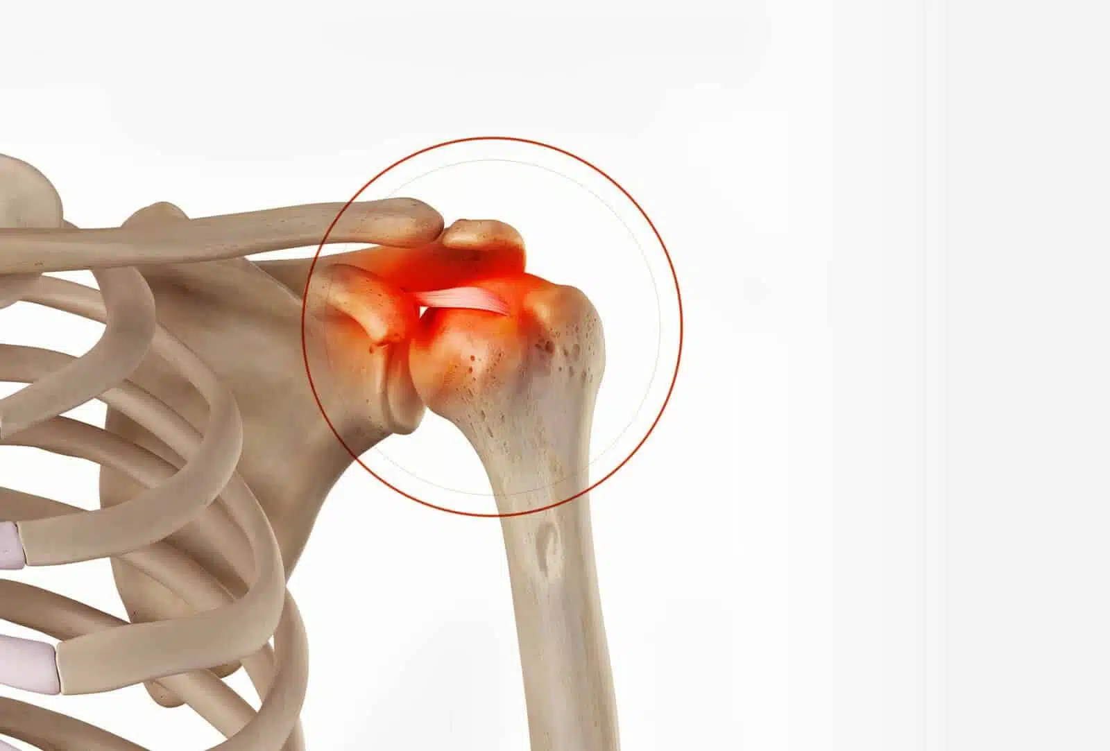 Chirurgie de l’épaule à Paris: Stabilisation acromio-claviculaire - Dr Paillard, Chirurgien orthopédique