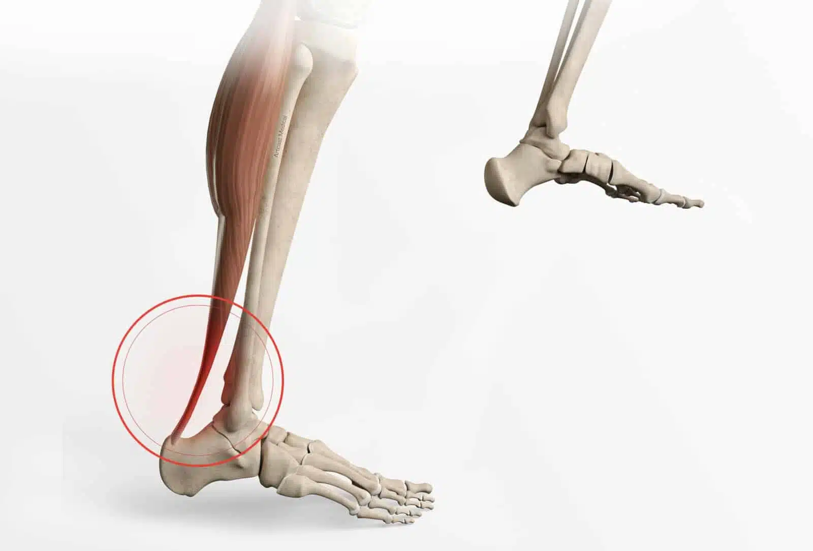 Définition de la pathologie des tendons fibulaires par docteur Paillard: Chirurgien orthopédique