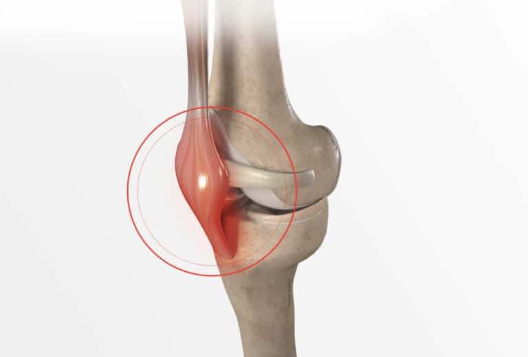 Symptômes et diagnostic de la tendinite du talon rotulien Dr Paillard