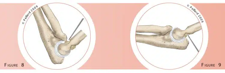 Qu’est ce qu’une arthrolyse du coude? Définition par dr Paillard: Chirurgien orthopédique