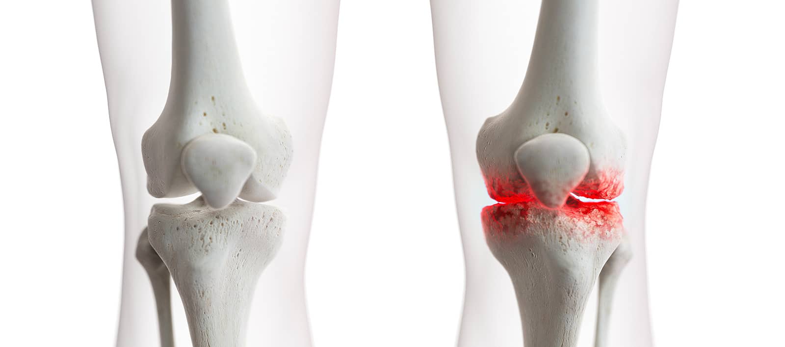 Déterminer les différents symptômes d’un problème au genou | Dr Paillard