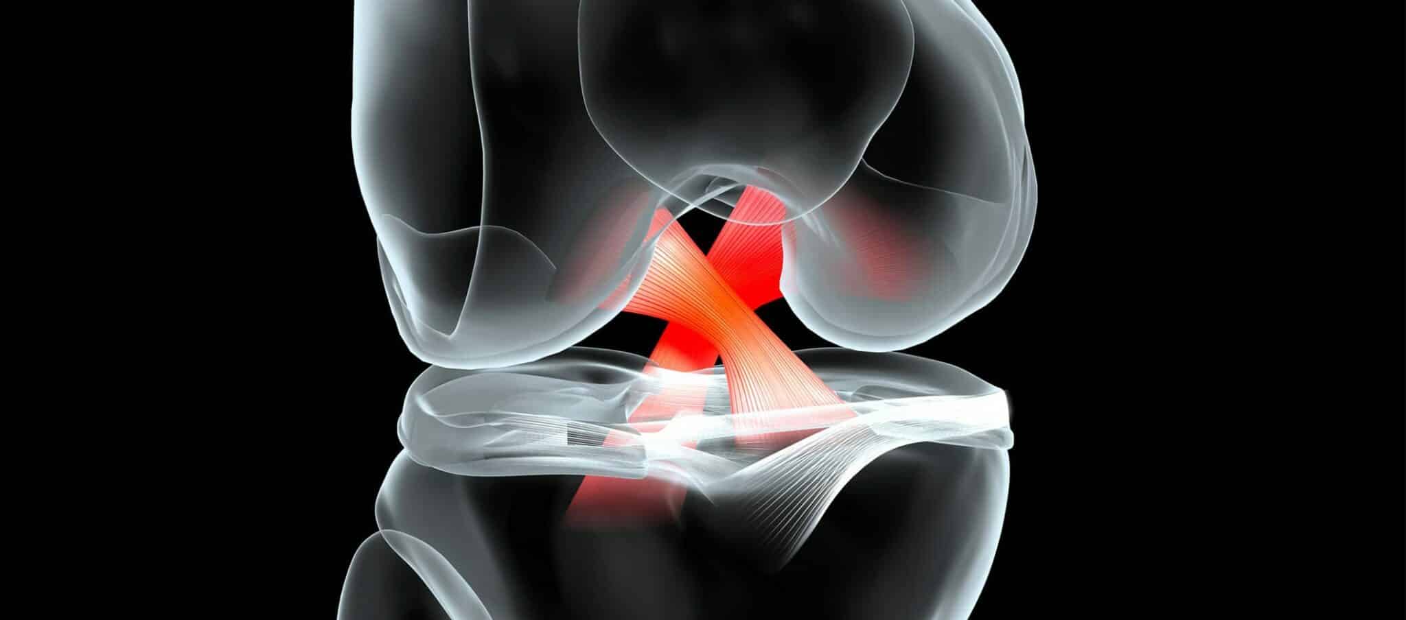 Rupture du ligament croisé - traiter sa pathologie du genou à Paris | Dr Paillard