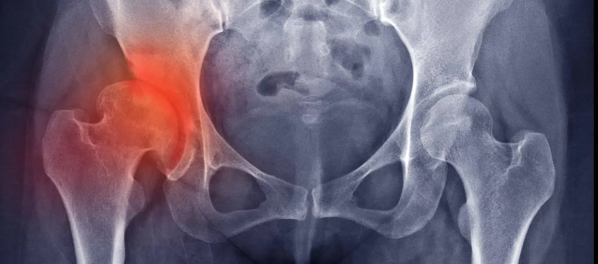 Comment diagnostiquer une dysplasie de la hanche ? | Dr Paillard | Paris