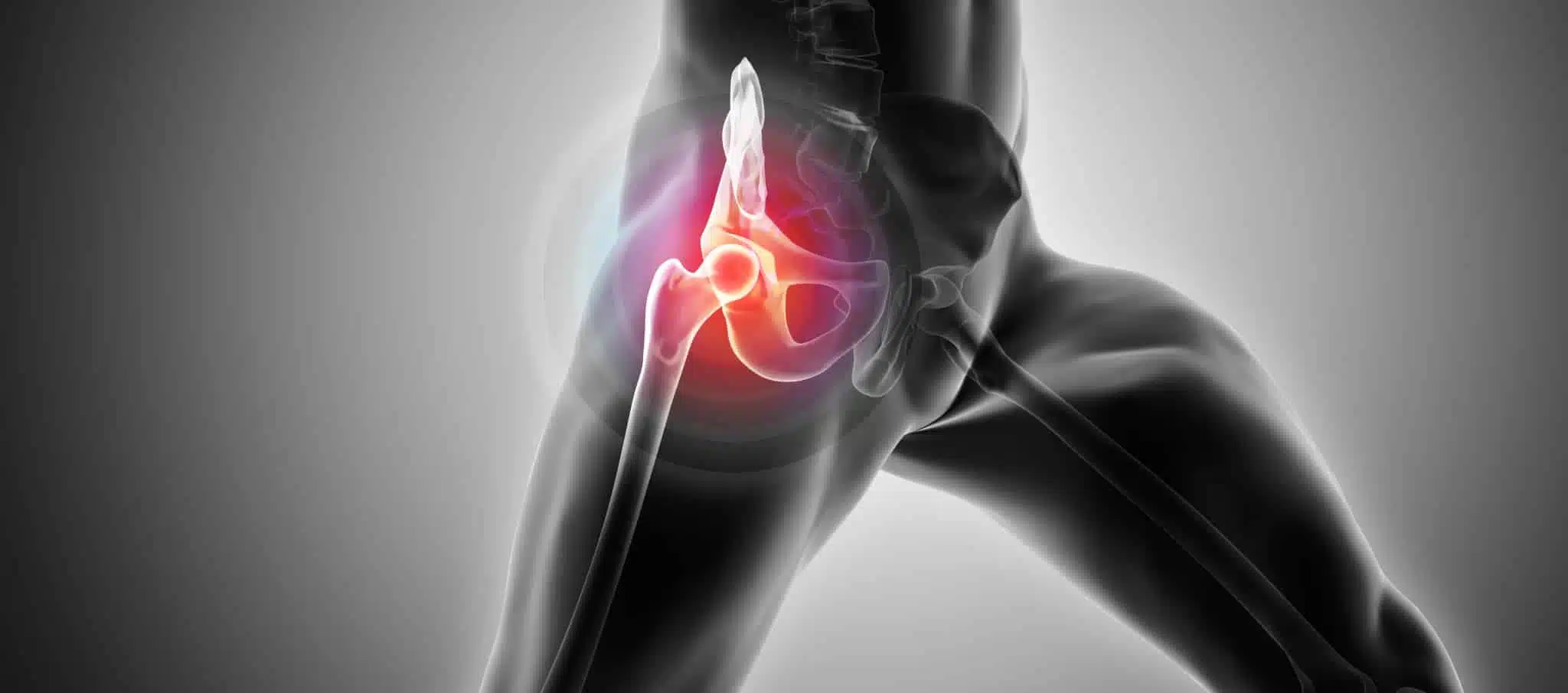 Rétablissement pose prothèse hanche | Dr Paillard | Paris