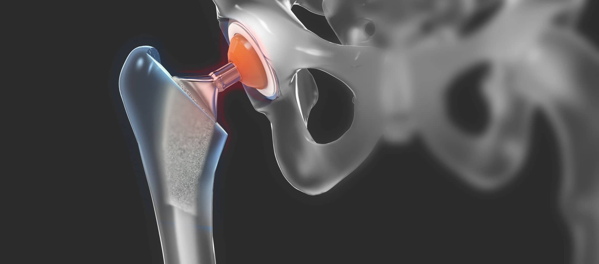 Est-ce qu’une prothèse de hanche peut bouger ? | Dr Paillard | Paris