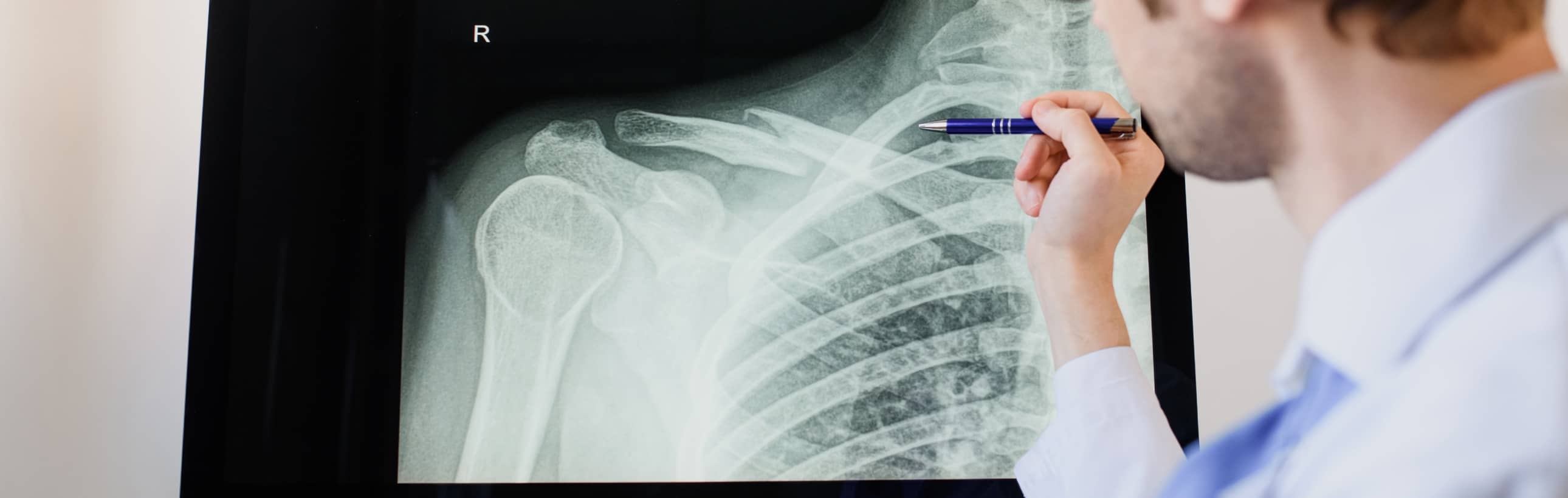 Fracture de l'omoplate durant le sport : comment réagir ? | Dr Paillard | Paris