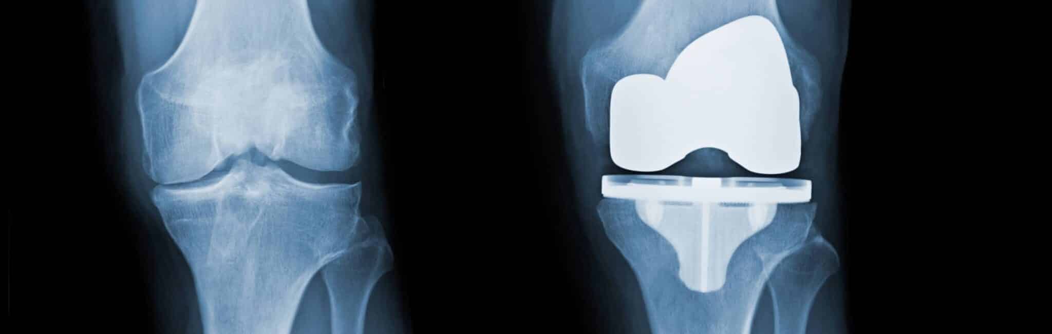 Comment prendre soin de sa prothèse de genou ? | Dr Paillard | Paris