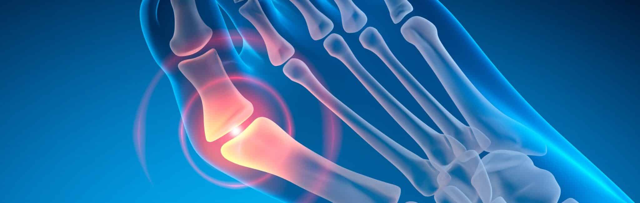 Chirurgie de l’hallux valgus avec le Dr Paillard à Paris